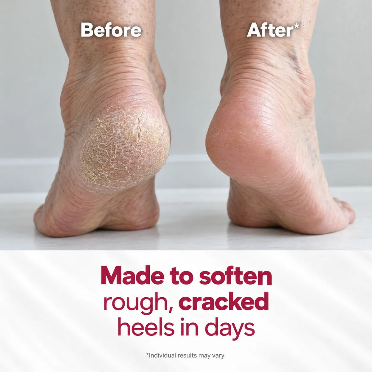 Urea And Salicylic Acid Hand And Foot Stick