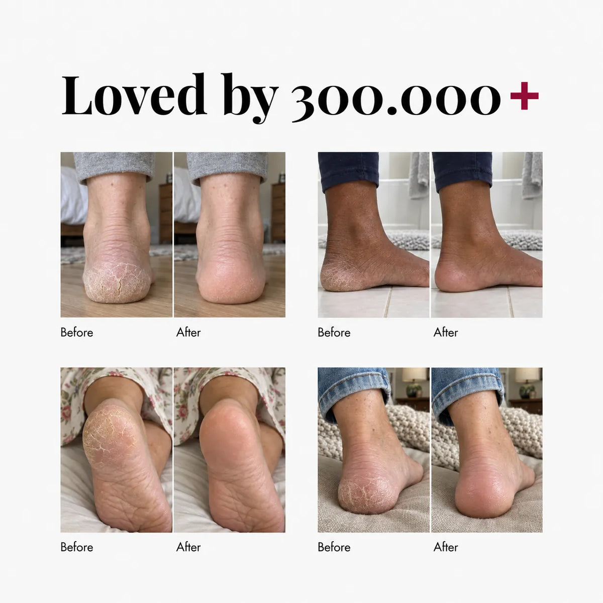 Urea And Salicylic Acid Hand And Foot Stick